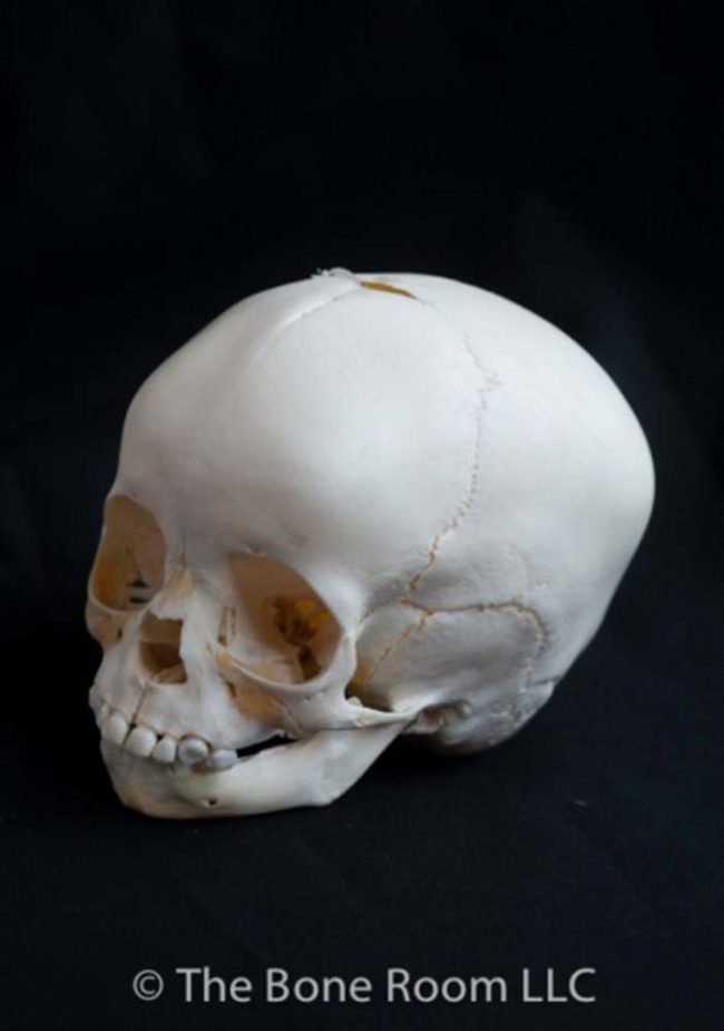 This 2-year-old's skull is in good condition. You can see that the child had 16 teeth at the time of death.