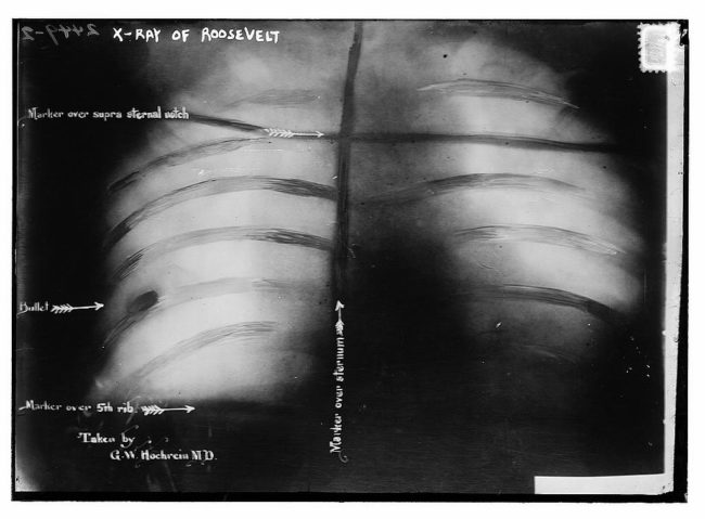 The bullet did not penetrate his pleura, meaning that it would be more dangerous to remove it than it would be to leave it in place. Teddy kept the bullet in there for the rest of his life.