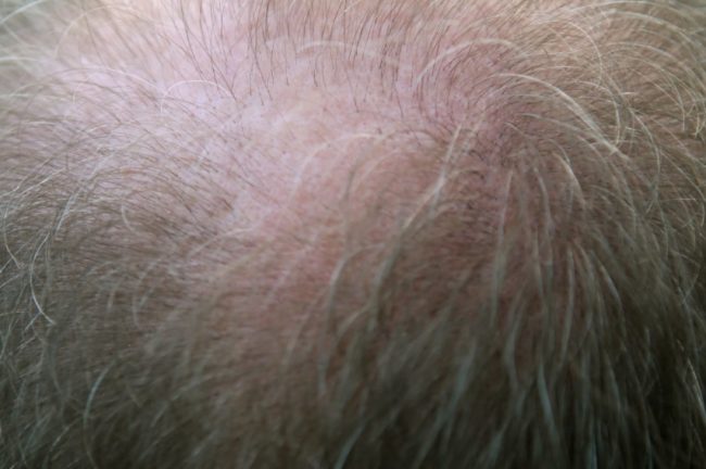According to the scientists, the osteoporosis drug targets a protein that acts as a brake on hair growth and plays a key role in hair loss. It may even be able to treat women with alopecia.